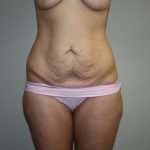 Tummy Tuck Before & After Patient #2135