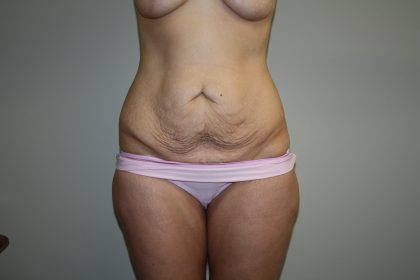 Tummy Tuck Before & After Patient #2135