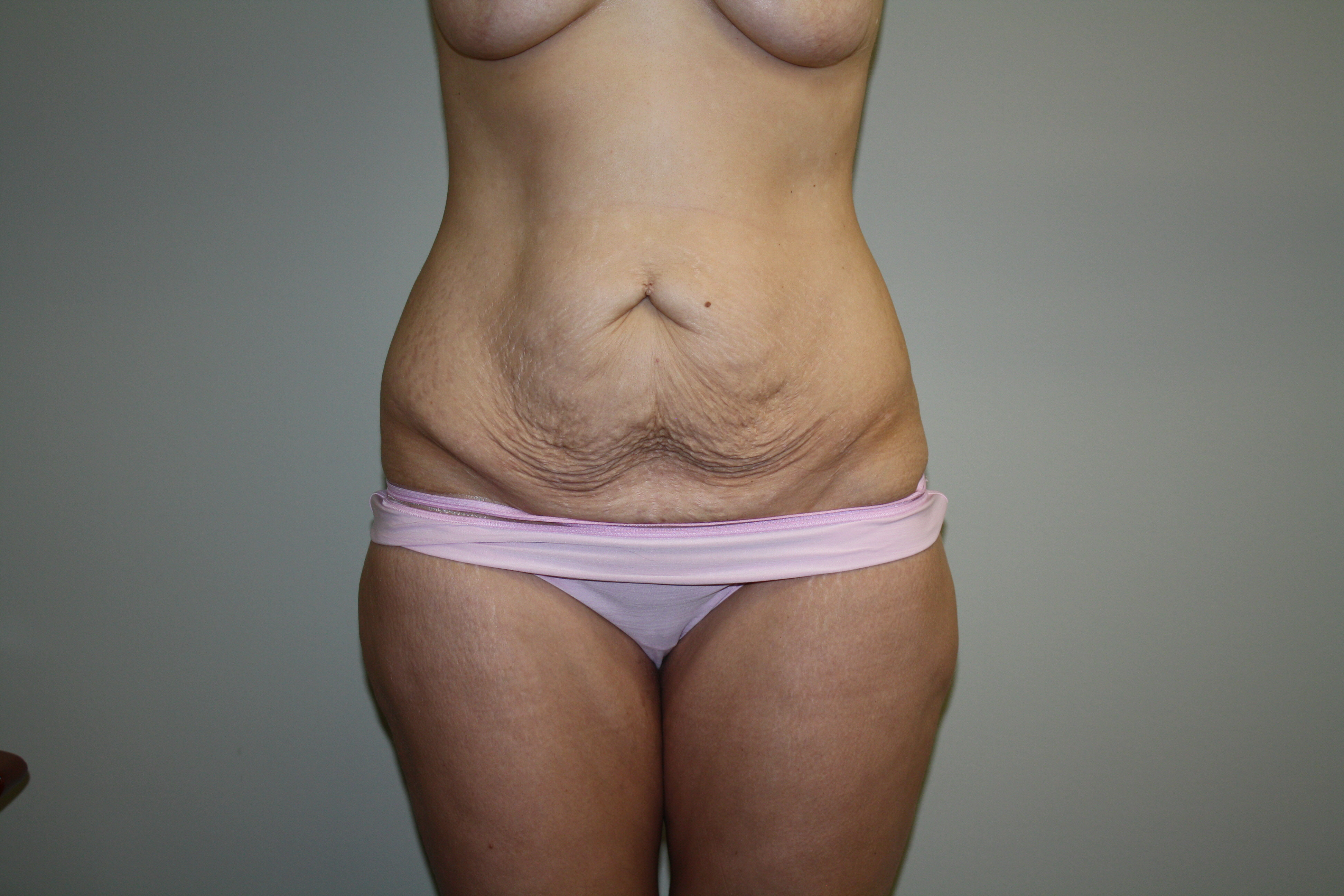 Tummy Tuck Before & After Patient #2135