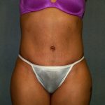 Tummy Tuck Before & After Patient #2223