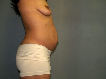 Tummy Tuck Before & After Patient #2223