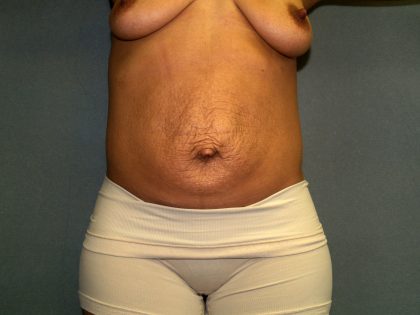 Tummy Tuck Before & After Patient #2223