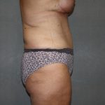 Tummy Tuck Before & After Patient #2023