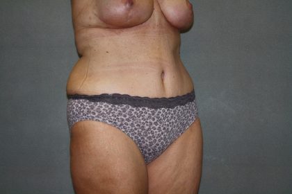 Tummy Tuck Before & After Patient #2023