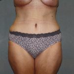 Tummy Tuck Before & After Patient #2023