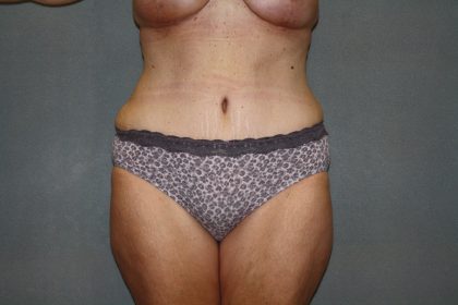 Tummy Tuck Before & After Patient #2023