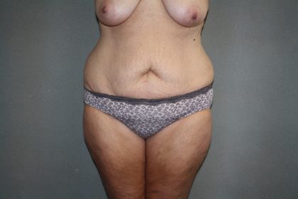 Tummy Tuck Before & After Patient #2023