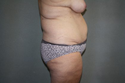 Patient #2023 Tummy Tuck Before and After Photos Beachwood - Plastic Surgery  Gallery Cleveland, Ohio - Dr. Gregory Fedele