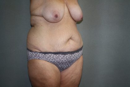 Tummy Tuck Before & After Patient #2023