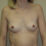 Breast Augmentation Before & After Patient #2843