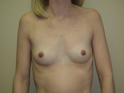 Breast Augmentation Before & After Patient #2843