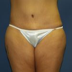 Circumferential Tummy Tuck Before & After Patient #913