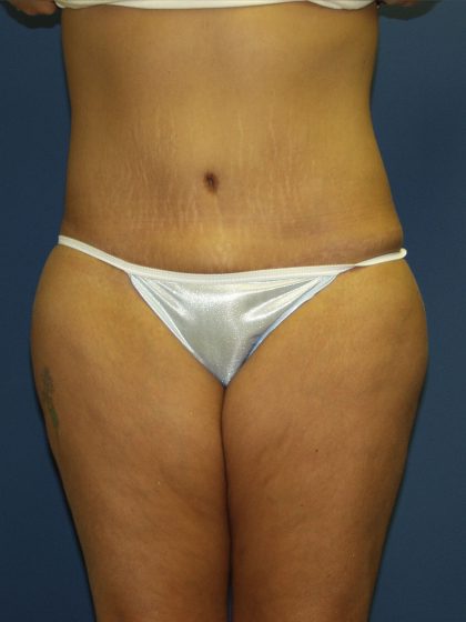 Circumferential Tummy Tuck Before & After Patient #913