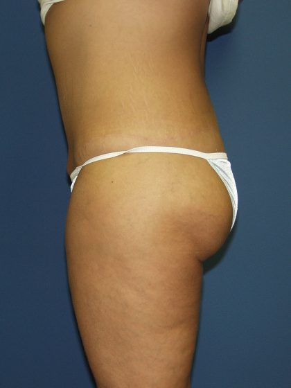 Circumferential Tummy Tuck Before & After Patient #913