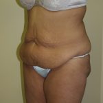 Circumferential Tummy Tuck Before & After Patient #913