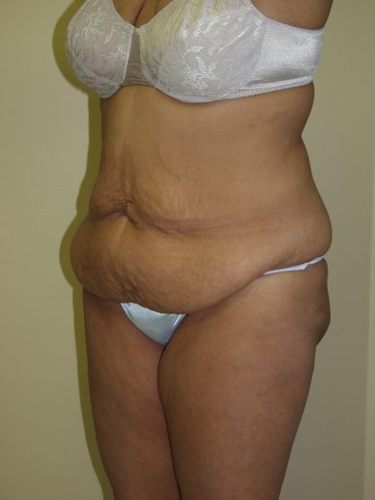 Circumferential Tummy Tuck Before & After Patient #913