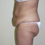 Circumferential Tummy Tuck Before & After Patient #913