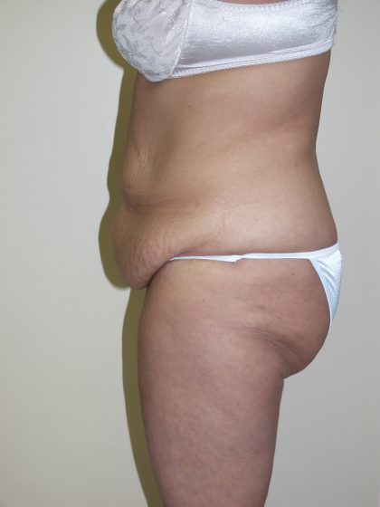 Circumferential Tummy Tuck Before & After Patient #913