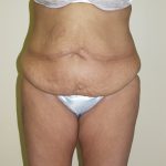 Circumferential Tummy Tuck Before & After Patient #913