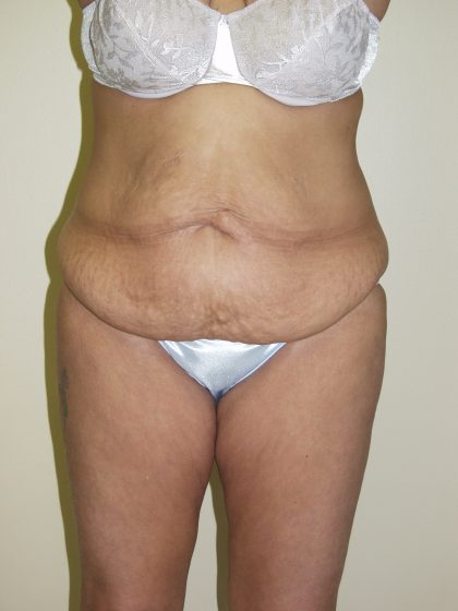 Circumferential Tummy Tuck Before & After Patient #913