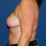 Breast Reduction Before & After Patient #3510