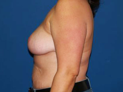 Breast Reduction Before & After Patient #3510