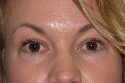 Eye Lid Lift Before & After Patient #706