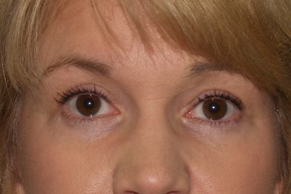 Eye Lid Lift Before & After Patient #706