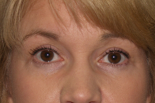 Eye Lid Lift Before & After Patient #706