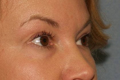 Eye Lid Lift Before & After Patient #706