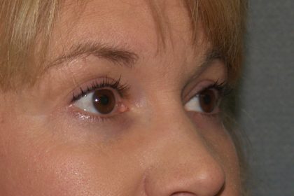 Eye Lid Lift Before & After Patient #706