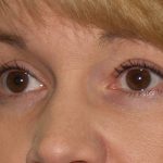 Eye Lid Lift Before & After Patient #706