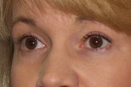 Eye Lid Lift Before & After Patient #706