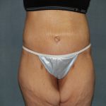 Circumferential Tummy Tuck Before & After Patient #920