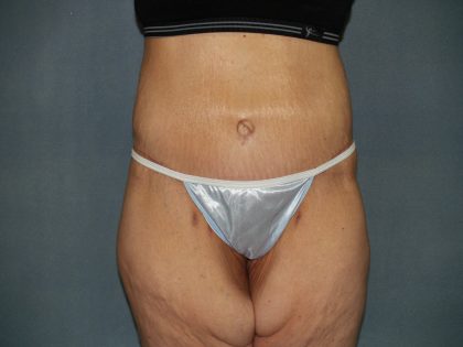 Circumferential Tummy Tuck Before & After Patient #920