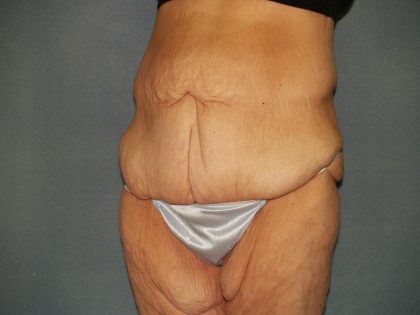 Circumferential Tummy Tuck Before & After Patient #920