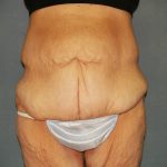 Circumferential Tummy Tuck Before & After Patient #920