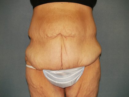 Circumferential Tummy Tuck Before & After Patient #920