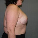 Breast Reconstruction Before & After Patient #2324