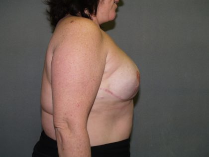 Breast Reconstruction Before & After Patient #2324