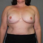 Breast Reconstruction Before & After Patient #2324