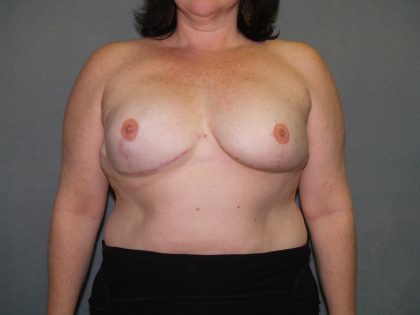 Breast Reconstruction Before & After Patient #2324