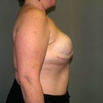 Breast Reconstruction Before & After Patient #2324