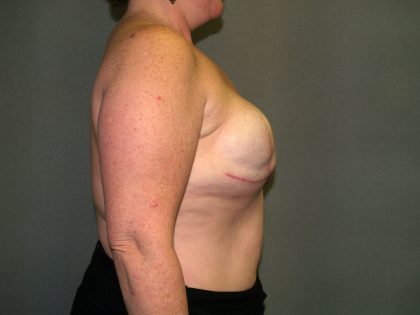 Breast Reconstruction Before & After Patient #2324