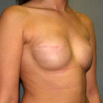 Breast Reconstruction Before & After Patient #1711