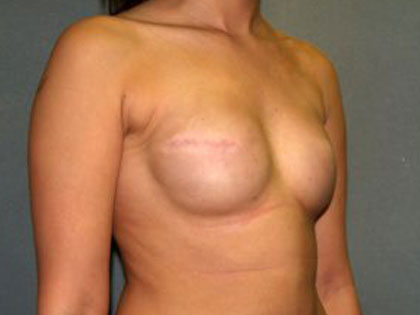 Breast Reconstruction Before & After Patient #1711