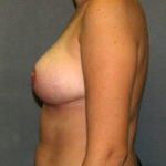 Breast Reduction Before & After Patient #3415