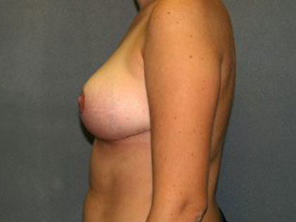 Breast Reduction Before & After Patient #3415