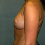 Breast Reconstruction Before & After Patient #1711