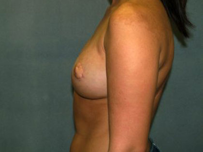 Breast Reconstruction Before & After Patient #1711